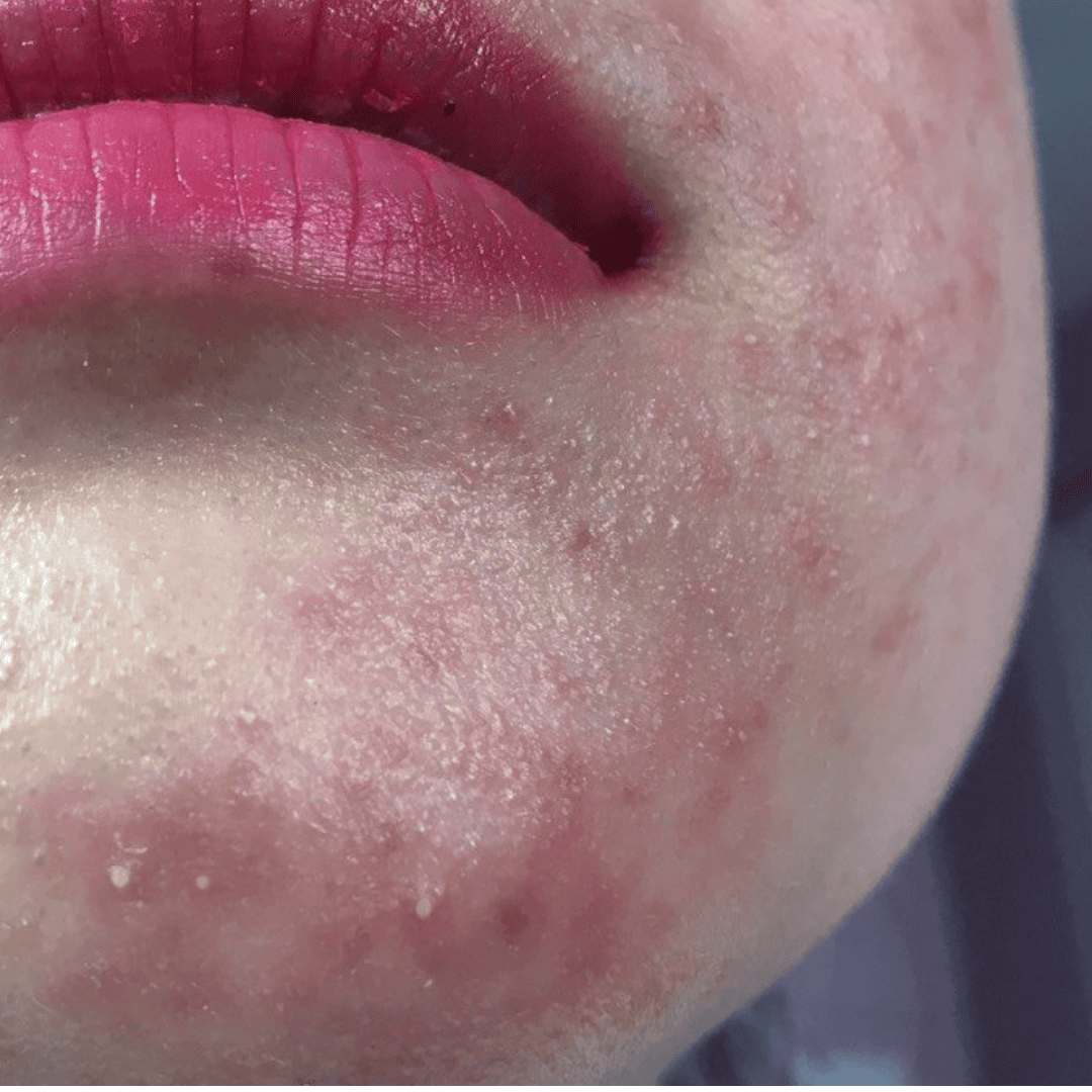 Thải độc cho da nhiễm corticoid, da dùng rượu thuốc