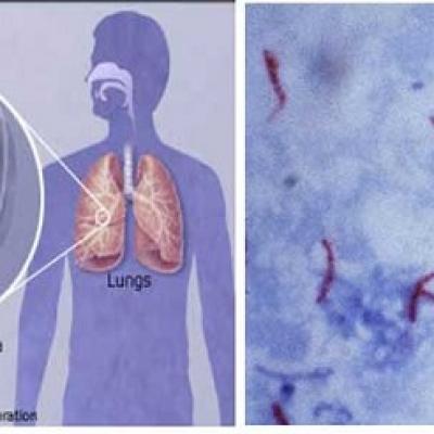 Câu chuyện về vi khuẩn trong sữa chua và vắc-xin bệnh lao