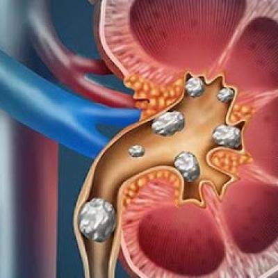 Phòng chống sỏi thận với những chiến lược sau